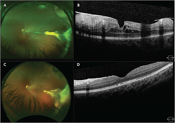 Figure 3. Incontinentia pigmenti. This patient with IKBKG deletion and mosaicism presented with a retinal fold OS and peripheral avascular retina OU and underwent photocoagulation (A). She subsequently developed a progressive epiretinal membrane (A, B). After undergoing vitrectomy and membrane peel, she had significant recovery in her retinal anatomy as noted at 6-year follow-up (C, D)