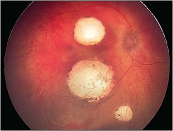 Figure 6. Handheld Retcam (Natus Medical Incorporated) fundus camera image of the right eye in a child with treated germline retinoblastoma.
