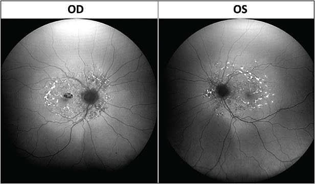 Figure 2. Fundus autofluorescence of a patient who presented with a complaint of vision loss demonstrated scattered yellow-white pisciform fundus flecks throughout the posterior pole.