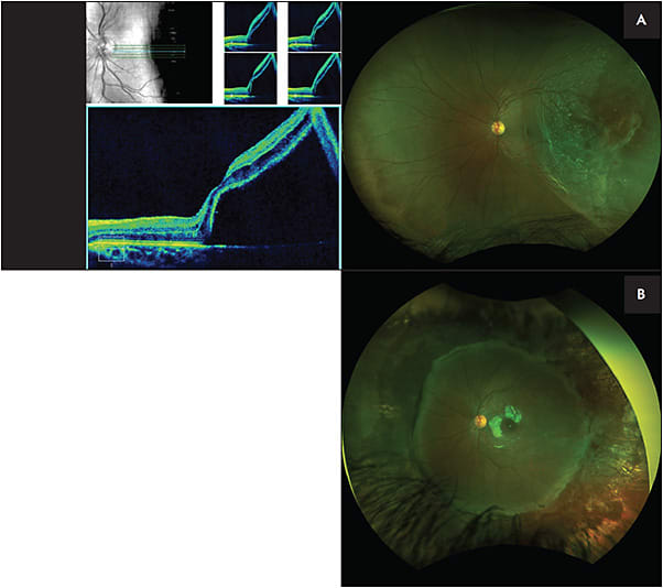 Figure 1. An 11-year-old male presented with a macula-involving retinal detachment with 3 temporal breaks (A). This patient underwent combined scleral buckle and vitrectomy surgery with placement of 1000 cs silicone oil. Fundus photo of the same patient 3 months postoperatively (B) shows an attached retina with an encircling band. Images courtesy of Audina M. Berrocal, MD and Patrick Staropoli, MD