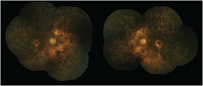 Figure 1. Color fundus photograph of a 70-year-old man with end-stage retinitis pigmentosa showing attenuated retinal arterioles, RPE atrophy, hyperplasia with bone spicule pigmentation, and waxy optic nerve pallor. 
COURTESY OF AJAY E. KURIYAN, MD.