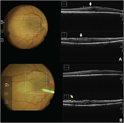 Figure 2. Intraoperative OCT (Zeiss Rescan 700) utility in epiretinal membrane (ERM) peel removal. Pre-ERM peel clearly identifies ERM (white arrows) (A). Post-ERM peel with minimal residual membrane (yellow arrow) (B).