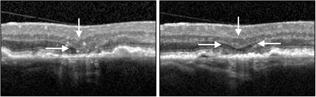 Figure 1.  Optical coherence tomography B scans showing a region of nascent geographic atrophy (nGA). White arrow: subsidence of outer plexiform layer and inner nuclear layer; arrow head: hyporeflective wedge-shaped lesion in Henle’s nerve fiber layer.