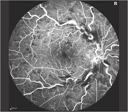 Figure 1. Fluorescein angiogram of the right eye of a patient with a central retinal vein occlusion.