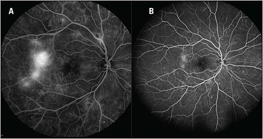 Figure 1. Compared with 55° fluorescein angiography (A), widefield fluorescein angiography (B) provides a more accurate assessment of the extent of proliferative diabetic retinopathy in this patient.
Images courtesy of David Eichenbaum, MD