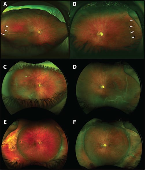 Figure 1. Optos ultrawidefield fundus photography of both eyes. Fundus photographs taken at the initial optometric examination show avascular retina temporally and tortuosity of posterior vessels in the right eye (A) and the left eye (B). A temporal ridge was present in both eyes (A and B, arrows). Fundus photographs taken 2 years later demonstrate macula-involving rhegmatogenous retinal detachments in both eyes (C, D). Fundus photographs taken 2 months after scleral buckling and cryotherapy of both eyes show resolution of retinal detachment (E, F). Photos courtesy of J. Peter Campbell, MD, Oregon Health &amp; Science University