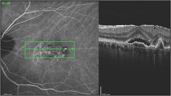 Figure 2. B scan optical coherence tomography correlated with indocyanine green angiography. Note the branching vascular network adjacent to a polypoidal choroidal neovascular complex.