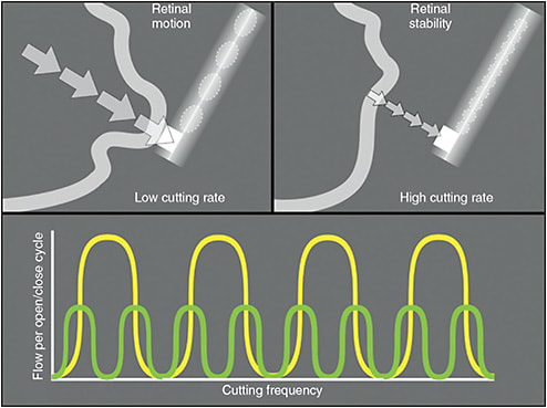 Figure 2. High cutting rates decrease pulsatile vitreoretinal traction. From Sadda SVR, Wilkinson CP, Wiedemann P, et al. Principles and techniques of vitreoretinal surgery. In: Ryan’s Retina. 7th ed. Elsevier; 2023:2040-2056. Used with permission from Elsevier Health Sciences.