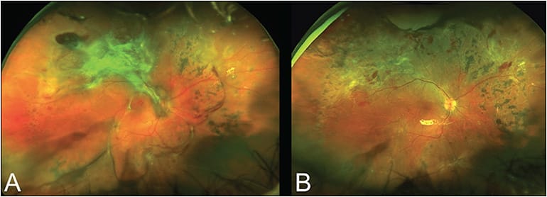 Figure 1. Wide-angle Optos preoperative photo of the right eye of a 35-year-old woman with type 1 diabetes who experienced progressively decreased visual acuity to hand motions. A large frond of fibrovascular membranes is seen superotemporally, causing a tractional retinal detachment in that area. A peripheral tractional and rhegmatogenous retinal detachment is seen from 12 o’clock to 8 o’clock. The patient underwent a bevacizumab injection 3 days before vitrectomy (A). Wide-angle Optos postoperative photo of the right eye 1 month post 27-gauge vitrectomy with probe-only lift, shave dissection techniques, and 1,000-centistoke silicone oil tamponade. The retina is fully attached, and the best corrected visual acuity is 20/70 (B).