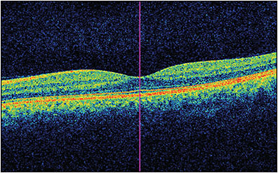 Figure 1. Optical coherence tomography image centered on the fovea (left eye).