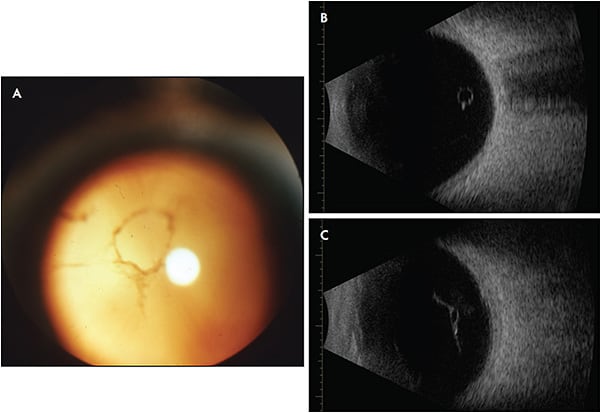 Figure 1. Following posterior vitreous detachment, a Weiss ring (former site of vitreopapillary adhesion) can sometimes be seen via fundus photography (A) and ultrasonography (B). The detached posterior vitreous cortex can also be imaged by ultrasound (C). Reprinted with permission from Sebag J, ed. Vitreous in Health and Disease. Springer; 2014:193-222.