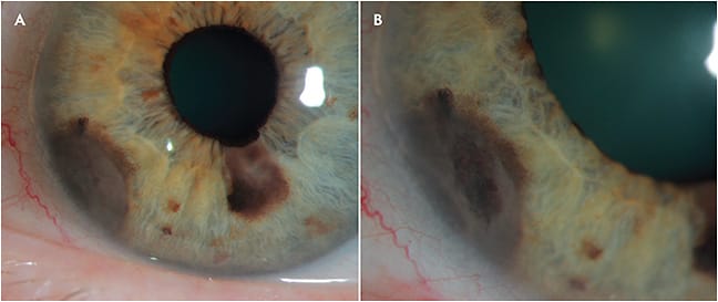 Figure 1. A 62-year-old female was evaluated for a growing iris nevus. Visual acuity was 20/25 in both eyes with normal intraocular pressure. The lesion was brown colored, located at the 6:30 to 8-o’clock position, and extended into the anterior-chamber angle. Ultrasound biomicroscopy confirmed a posterior extension to the pars plicata with tumor dimensions measuring 2.9 mm x 2.8 x 1.8 mm in size. A transcorneal fine-needle aspiration biopsy was performed with a short angulated 25-gauge needle. The needle was inserted at the 9-o’clock position, advanced along the iris plane, with a bevel up along the long axis of the tumor. Cytopathology revealed atypical cells derived from a melanocytic neoplasm, consistent with melanoma.