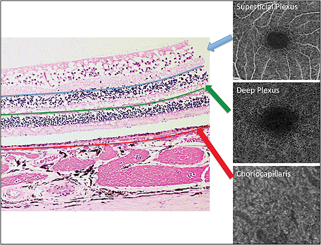 Figure 2. En face OCTA slabs of the superficial retinal plexus, deep retinal plexus, and choriocapillaris. The corresponding retinal layers on histology are denoted. Image courtesy Peter R. Egbert, MD, Stanford University, Stanford, California.