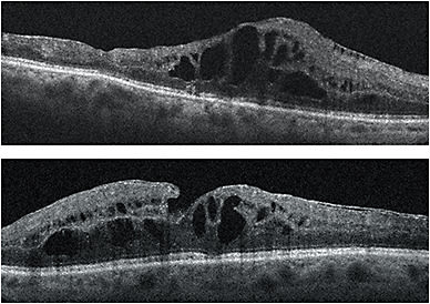 Figure 1. Both eyes prior to treatment with Iluvien, OD in Nov. 2015, OS in Sept. 2015.