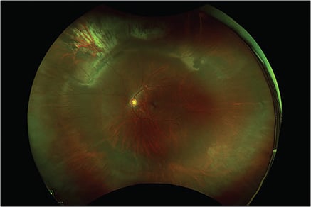 Figure 1. A 47-year-old phakic male patient 1.5 years status post primary scleral buckle, cryotherapy, and C3F8 gas for a superior macula on rhegmatogenous retinal detachment.