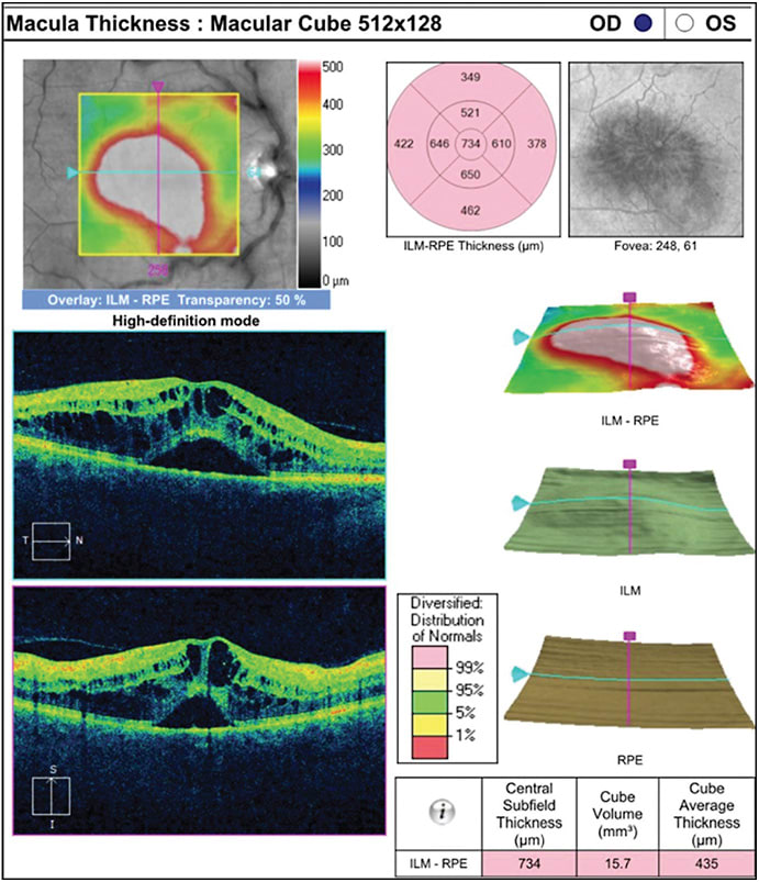 Figure 2. Optical coherence tomography of the right eye, from a patient with a central retinal vein occlusion, revealing severe cystoid macular edema with subretinal fluid.