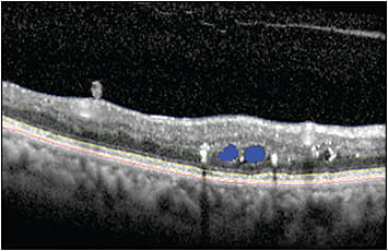 Figure 1.  Automated segmentation of retinal layers and pathology in an optical coherence tomography image by deep convolutional neural network model. Blue, green, yellow, orange, and pink lines represent internal limiting membrane, outer plexiform layer-outer nuclear layer junction, ellipsoid zone, retinal pigment epithelium, and Bruch’s membrane, respectively. Blue filled circles represent cystic intraretinal fluid.