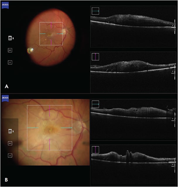 Figure 1. Intraoperative optical coherence tomography before (A) and after (B) a macular peel for a thick epiretinal membrane in the setting of proliferative vitreoretinopathy.