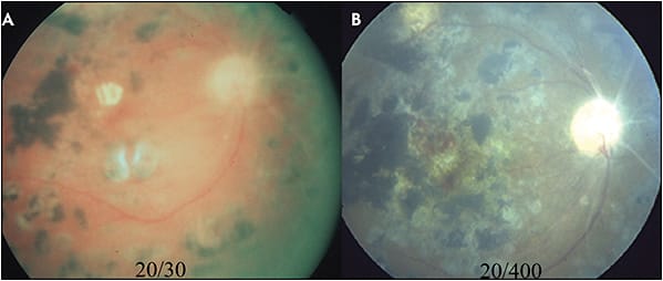 Figure 2. Color fundus photo of the right eye shows scattered laser photocoagulation scars (A). The patient’s VA at that time was 20/30. The color fundus photo shows the same eye 8 years later with no additional laser photocoagulation in between (B). The laser scars expanded in size and disrupted the architecture of the macula. The patient’s VA declined to 20/400.