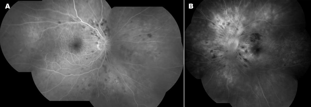 Figure 4. Right (A) and left (B) eye pseudowidefield fluorescein angiogram montage images of the same patient demonstrating nonperfusion, ischemic changes, and diabetic macular edema leakage in both eyes and leakage due to neovascularization elsewhere in the left eye.