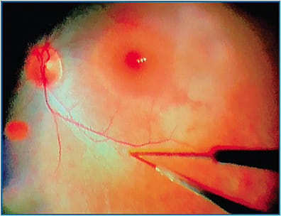 Figure 2. Surgeon&#8217;s view of patient&#8217;s right eye illustrating the recommended site of subretinal injection along the superotemporal arcade at least 2 mm away from the foveal center, avoiding major vessels or areas of pathologic changes.&#xA;Courtesy of Tahira Scholle, MD, and J. Timothy Stout, MD, MBA, PhD, Baylor College of Medicine&#xA;