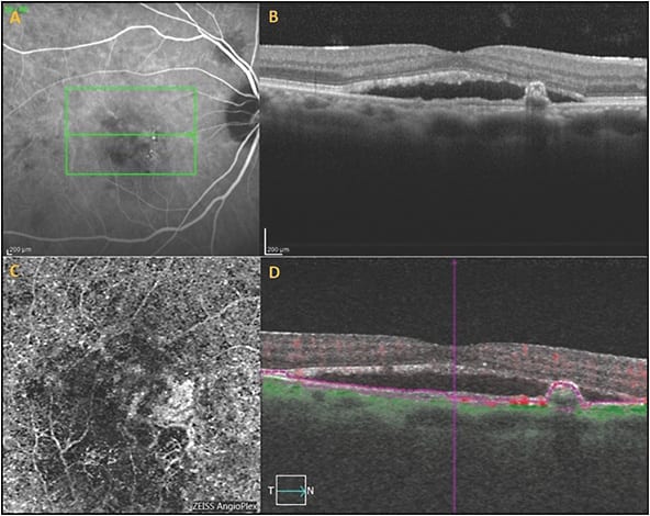 Figure 3. Optical coherence tomography angiography (OCTA) showing less resolution of the polypoidal choroidal vasculopathy complex by OCTA than indocyanine green angiography, possibly due to slower flow through the polypoidal lesions. Indocyanine green angiography of the polypoidal choroidal vasculopathy (PCV) complex (A). Optical coherence tomography angiography of the PCV complex (B). Note the poorer visualization of the polypoidal lesions on the OCTA.