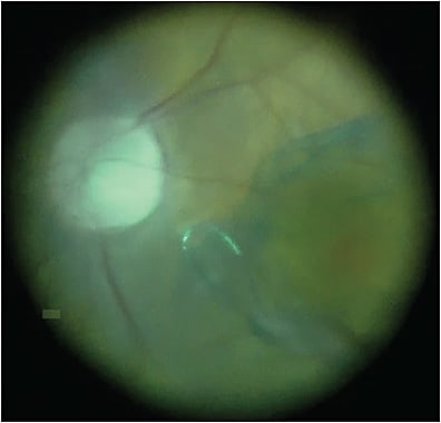 Figure 3. The Alcon Finesse Flex Loop is used to engage the internal limiting membrane and then peel it.