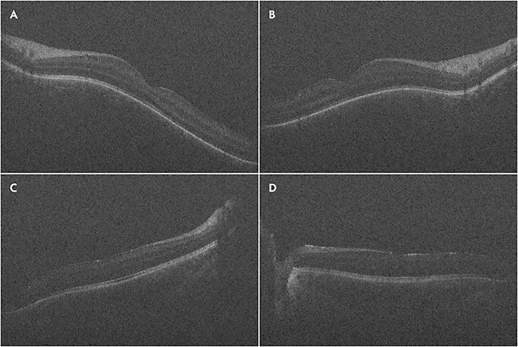 Figure 1. Handheld OCT (Envisu; Leica Microsystems) showing normal foveal contour during exam under anesthesia of an infant with retinopathy of prematurity (A, B). Envisu probe showing effaced foveal contour in an infant with treated retinopathy of prematurity (C, D).