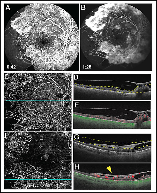 Figure 2. Fluorescein angiography (FA) and swept-source optical coherence tomography angiography (SS-OCTA) scans (12x12 mm; Zeiss Plex Elite 9000) of a patient with active proliferative diabetic retinopathy. 50-degree early phase of FA image showing extensive neovascular proliferation and peripheral nonperfusion (A). 50-degree late phase FA image showing late hyperfluorescence and leakage (B). SS-OCTA 12x12 mm en face total retinal slab and the corresponding horizontal B-scan represented by a blue line through the fovea demonstrating the neovascularization and peripheral nonperfusion seen on the FA images (C). Horizontal B-scans with or without segmentation lines and color-coded flow (D, E). Red color represents flow in the retina and the green color represents flow in the choroid. The dashed yellow lines in panel D depict the location of the cross-sectional B-scan shown in panel C, which shows the neovascular membranes with traction at the macula and disc. SS-OCTA 12x12 mm en face vitreoretinal interface slab identifies the neovascular proliferation (F). Horizontal B-scans with or without segmentation lines and color-coded flow (G, H). The dashed yellow lines in panel G depict the location of the blue cross-sectional B-scans shown in panel F, which shows neovascular proliferation along the inferior arcade highlighted with a yellow arrowhead in panel H.