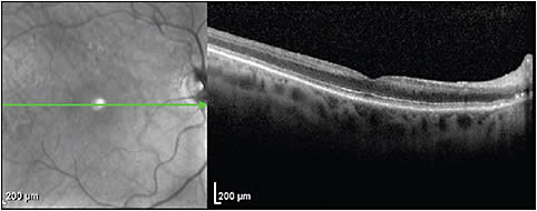 Figure 2. Chronic central retinal artery occlusion. Optical coherence tomography (Heidelberg Spectralis) shows thinning of the inner retinal layers with preservation of the identifiable layers