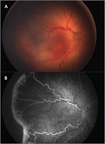 Figure 1. Fundus imaging obtained in the operating room in a patient with retinopathy of prematurity. Fundus photograph of a patient with posterior zone II, stage 3 with plus disease (A) with corresponding fluorescein angiography (B).