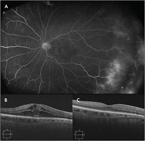 Figure 1. Late-phase widefield fluorescein angiography (FA) (Optos) of the left eye on presentation demonstrating macular and peripheral vascular leakage (A). The right eye had similar FA findings. Spectral domain optical coherence tomography (SD-OCT) (Zeiss) of the right eye on presentation revealing cystoid macular edema with a sliver of subretinal fluid (B). SD-OCT of the right eye 4 months following treatment with a single dose of intravitreal triamcinolone acetonide revealed complete resolution of macular edema (C).