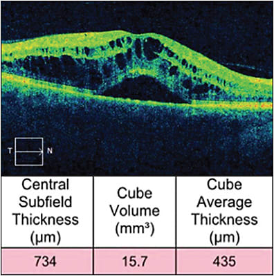 Figure 2. Central retinal vein occlusion-associated severe cystoid macular edema, subfoveal fluid, and associated disruption of the ellipsoid zone. Note the highly elevated central subfield thickness.