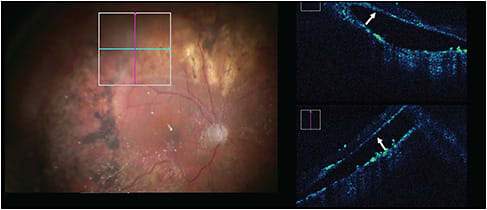 Figure 4. Retinal detachment with proliferative vitreoretinopathy and subretinal membranes identified with iOCT (white arrows) (Zeiss Rescan 700).