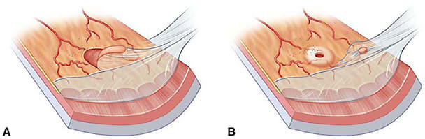 Figure 3. Vitreous traction during surgical induction of posterior vitreous detachment (PVD) can induce peripheral vitreoretinal traction with resultant tears (A) or holes (B). Reprinted with permission from Sebag J, ed. Vitreous in Health and Disease. Springer; 2014:716.