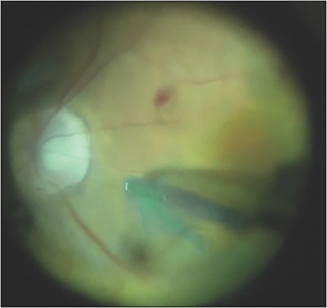 Figure 4. In this case, the internal limiting membrane is peeled across the fovea as opposed to circumferentially.