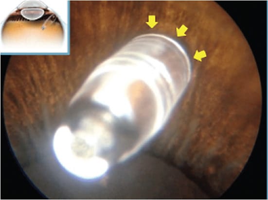 Figure 1: This is a view from the internal perspective. There is a 3.5 mm scleral incision without suturing. Initially, this led to vitreous hemorrhages due to a lack of homeostasis. Bleeding can be prevented with laser ablation of the pars plana.