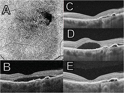 Figure 1. A 61-year-old male patient presented with 20/200 vision in his left eye. He was being treated at another local institution with eplerenone 50 mg daily by mouth for presumed central serous chorioretinopathy in the left eye, with no improvement