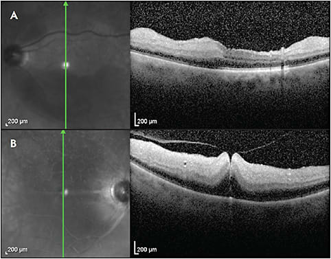 Figure 1. Acute central retinal artery occlusion with cilioretinal sparing (A). Optical coherence tomography (Heidelberg Spectralis) demonstrates thickening and hyperreflectivity from the nerve fiber layer to the inner nuclear layer.