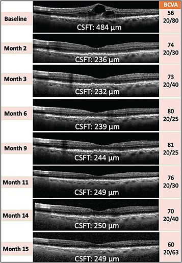 Figure 2. Case study. Preliminary biological signal of efficacy in a phase 1 clinical trial for a sustained-release TKI investigational candidate. A treatment-naïve participant diagnosed with neovascular AMD received OTX-TKI 600 µg intravitreally in the left eye. A substantial reduction of central subfield thickness from 484 µm at baseline was seen as early as 2 months (236 μm) after the procedure and was maintained until month 15 (249 μm) without the need for additional anti-VEGF injections.