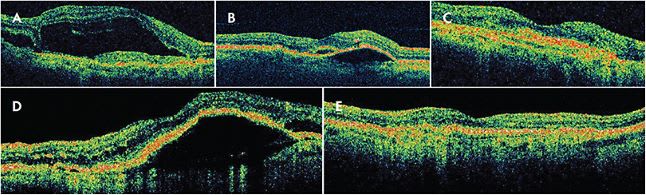 Figure 1. Anti-VEGF treatment response in nAMD is neither uniform in any patient over time nor is it similar across different patients