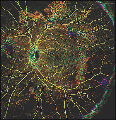 Figure 1. Montage 15 mm x 9 mm widefield swept-source optical coherence tomography angiography (Plex Elite 9000; Carl Zeiss Meditec) displaying “total retina” proliferative diabetic retinopathy with peripheral ischemia and numerous areas of peripheral neovascularization.