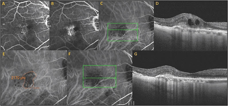 Figure 7. Resolution of retinal pigment epithelial detachment and subretinal fluid after combination photodynamic therapy (PDT) and bevacizumab 1.25 mg and dexamethasone 400 µg. Vision remained 20/40. This anatomic and visual improvement was maintained with good visual acuity and resolved edema and subretinal without further treatment for the rest of the patient’s life 6 years after combination PDT therapy.