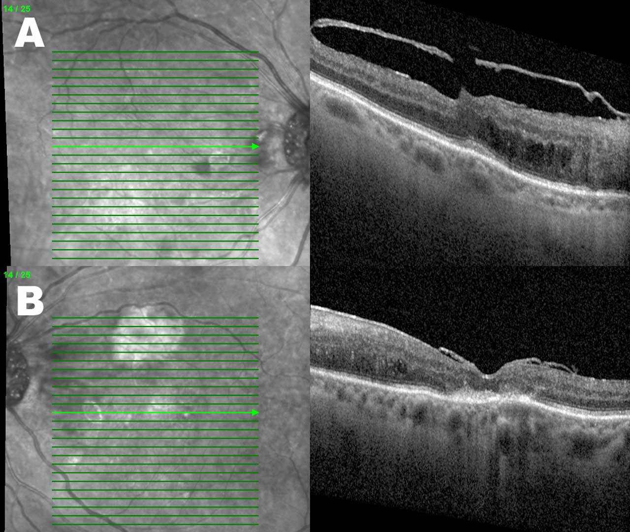 Figure 2. Right (A) and left (B) eye pseudowidefield color fundus montage images demonstrating severe nonproliferative diabetic retinopathy and macular edema in both eyes of a 68-year-old woman who presented with vision loss.