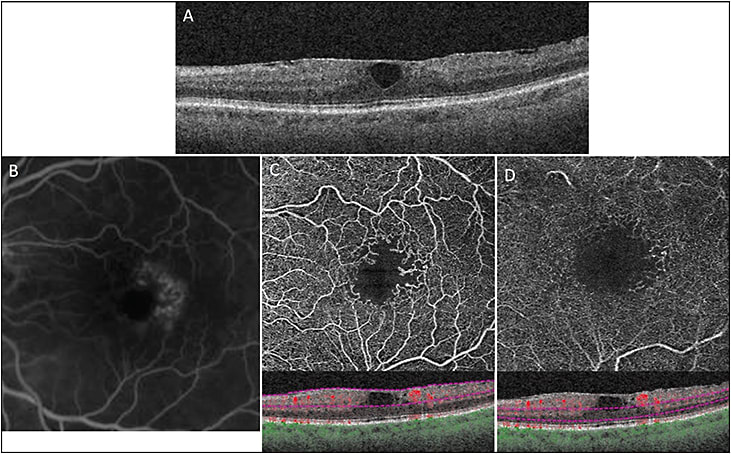 Figure 3. Macular telangiectasia. SD-OCT B-scan image shows foveal cysts with mild blurring of the perifoveal retinal layers (A). A mild epiretinal membrane with loss of foveal depression is also noted. Fluorescein angiogram shows temporal perifoveal telangiectatic changes with leakage (B). OCTA image the superficial (C) and deep (D) retinal vascular plexus show irregularity in the foveal avascular zone with temporal perifoveal vascular changes.