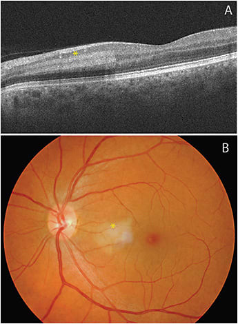 Figure 5. Optical coherence tomography shows a well-demarcated hyperreflective region spanning the inner plexiform, inner nuclear, and outer plexiform layers nasal to the fovea (A) and corresponding to the whitening observed clinically (B; note corresponding asterisks).