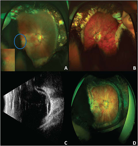 Figure 1. Rhegmatogenous retinal detachment in an adult with a history of retinopathy of prematurity. Color fundus photograph of the right eye shows a shallow retinal detachment associated with a temporal retinal break (blue circle and magnified insert) (A). Color fundus photograph of the left eye shows a myopic fundus with peripheral photocoagulation (B). B-scan of the right eye shows a complete retinal detachment (C). Following pars plana vitrectomy with scleral buckling and silicone oil, the retina was successfully reattached (D).