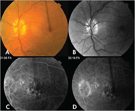 Figure 7. This 43-year-woman with a history of myotonic dystrophy was referred with blurring of central vision LE. VA measured 20/30 LE. Fundus examination revealed mild pigmentary changes in the macula (top left), corroborated on red-free fundus photography (top right). FA demonstrated patchy staining of the RPE mottling on early and late frames (bottom left and right respectively). These findings were consistent with myotonic dystrophy with pattern dystrophy of the macula.