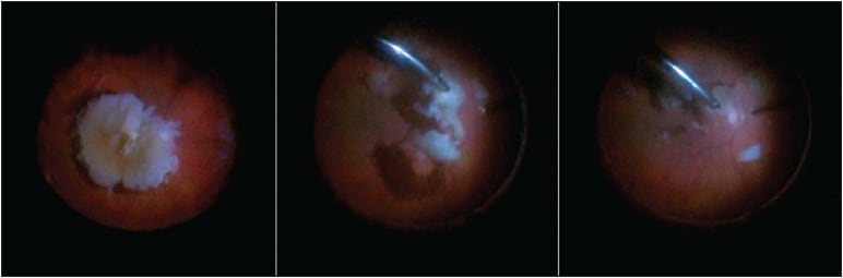 Figure 3. A large posteriorly dislocated lens nucleus (left) can be disassembled more efficiently with use of a fragmatome (center, right).
IMAGE COURTESY TALIA KADEN, MD, AND YASHA MODI, MD