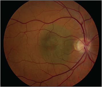 Figure 2. Traditional fundus photograph of a small macular choroidal melanoma. Note the faithful representation of the clumped orange pigment overlying the tumor.